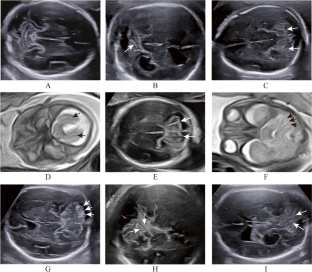 Prenatal Diagnosis of Cerebellar Cortical Dysplasia: Case Report