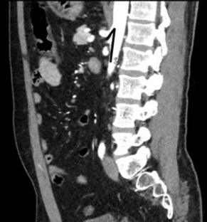 Exploring celiac trunk parameters in median arcuate ligament syndrome: A CT study