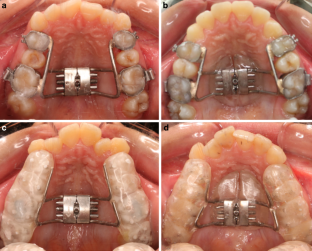 Transient bacteremia following the removal of four different types of rapid palatal expanders.