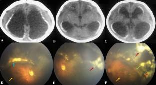 Calcifications and Chorioretinitis in Congenital Cytomegalovirus Infection