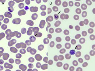 Co-Infectious Mystery: Why Artemether-Lumefantrine Cleared P. falciparum but Left P. malariae behind