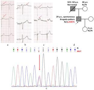 Novel Gain-of-Function Mutation in the Kv11.1 Channel Found in the Patient with Brugada Syndrome and Mild QTc Shortening