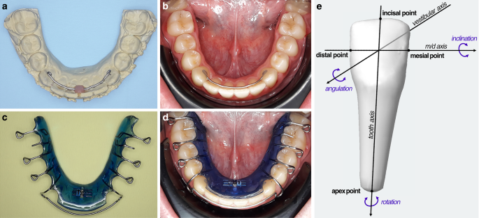 Low translational and rotational movements with 2-point stainless-steel retainers over a period of 1 and 3 years.