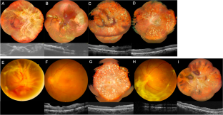 Bilateral vitrectomy in patients with proliferative diabetic retinopathy—characteristics and surgical outcomes