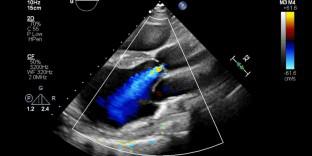 Management of aortic valve insufficiency in patients with continuous-flow left ventricular assist device: a republication of the review published in Japanese Journal of Artificial Organs