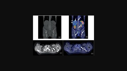 Prevalence of metastases outside the liver and abdominal lymph nodes on 68Ga-DOTATOC-PET/CT in patients with small intestinal and pancreatic neuroendocrine tumours