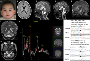 Role of TOE1 variants at the nuclear localization motif in pontocerebellar hypoplasia 7