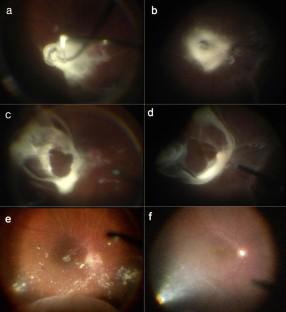 Selective internal limiting membrane peeling for prevention of secondary epiretinal membrane after vitrectomy for rhegmatogenous retinal detachment