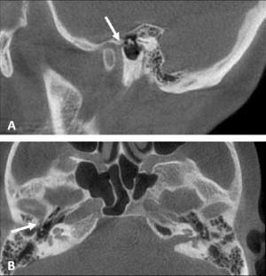 The relation between persistent foramen tympanicum and degenerative bone alterations in temporomandibular joint region