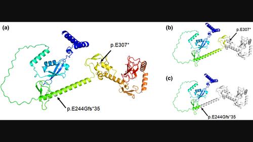 A case of polyglucosan body myopathy caused by an RBCK1 gene variant and literature review