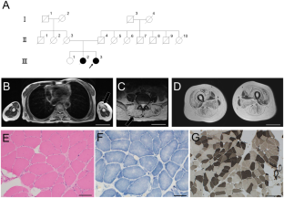 Long-term course of a case with a novel homozygous kyphoscoliosis peptidase variant