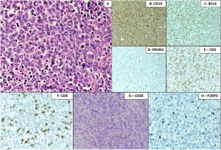 Prognostic Significance of T-Cells and Macrophages in the Tumour Microenvironment of Nodal DLBCL