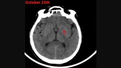 Experience of treatment in critical Guillain-Barre Syndrome case after COVID-19 vaccination