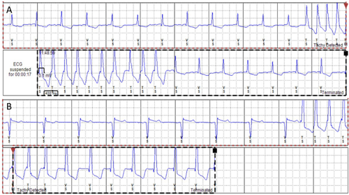 Arrhythmogenesis in Fabry Disease