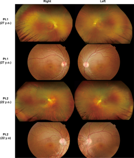 Clinical course of two siblings with potassium voltage-gated channel modifier subfamily V member 2 (KCNV2)-associated retinopathy