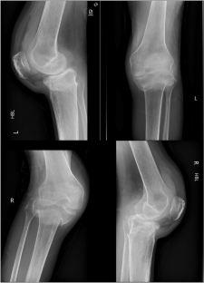 Bilateral tibial fractures associated with powered exoskeleton use in complete spinal cord injury – a case report & literature review