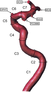 Investigation of the morphometric characteristics of internal carotid artery between sexes and in patients with intracranial aneurysms