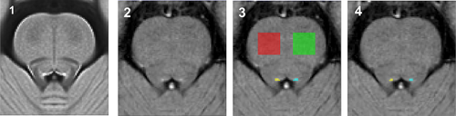 The degeneration of locus coeruleus occurring during Alzheimer’s disease clinical progression: a neuroimaging follow-up investigation