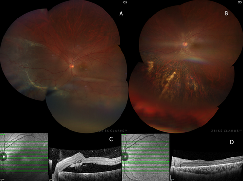 Invivo generated autologous plasmin enzyme assisted vitrectomy, partial circumferential-oral retinotomy, silicone oil injection in patients with chronic retinal detachment without posterior vitreous detachment