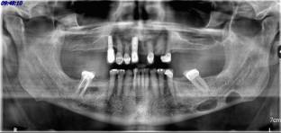 A rare case of unilateral double Stafne bone defects and literature review