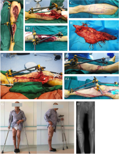 Early Experience of Combined Anterolateral Thigh Flap and Ilioinguinal Flap in Patients with Severe Lower Extremity Trauma