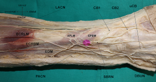 Superficial branch of the radial nerve passing through the supinator canal, emerging between the extensor digitorum and abductor pollicis longus muscles and consequently supplying the second finger and radial portion of the third finger: a case report and clinical implications