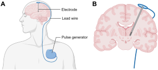 Real-Time Optimal Synthetic Inversion Recovery Image Selection (RT-OSIRIS) for Deep Brain Stimulation Targeting