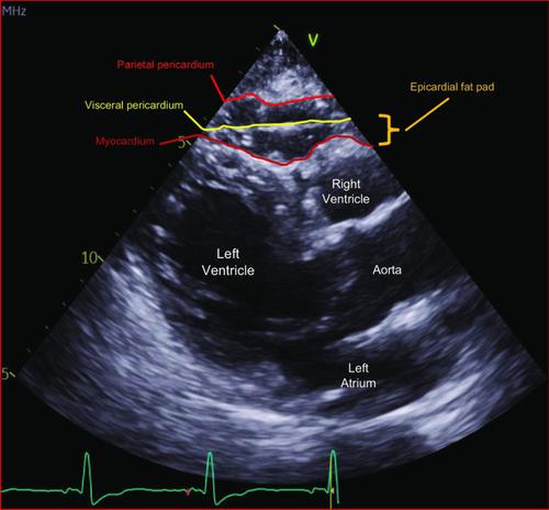 Epicardial Adipose Tissue Thickness and Preserved Ejection Fraction Heart Failure