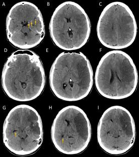 Treatment of Malignant Cerebral Edema in Acute Ischemic Stroke