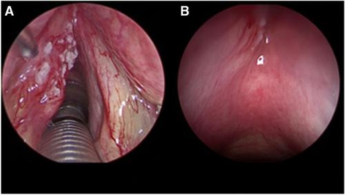 Current Status of Partial Laryngeal Surgery for Advanced Laryngeal Cancer: When and Why?