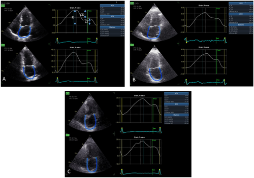 Evolving Applications of Echocardiography in the Evaluation of Left Atrial and Right Ventricular Strain.