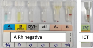 Naturally Occurring Anti-D in a Male Blood Donor, Unresolved Mystery