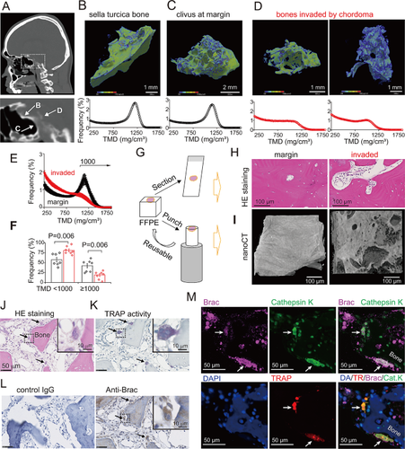 Chordoma cells possess bone-dissolving activity at the bone invasion front.