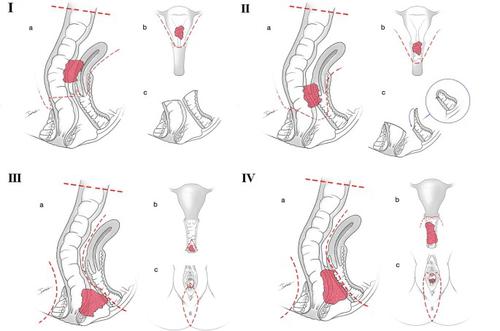 A novel classification of posterior pelvic exenteration to assess prognosis in female patients with locally advanced primary rectal cancer: a retrospective cohort study from China PelvEx collaborative.