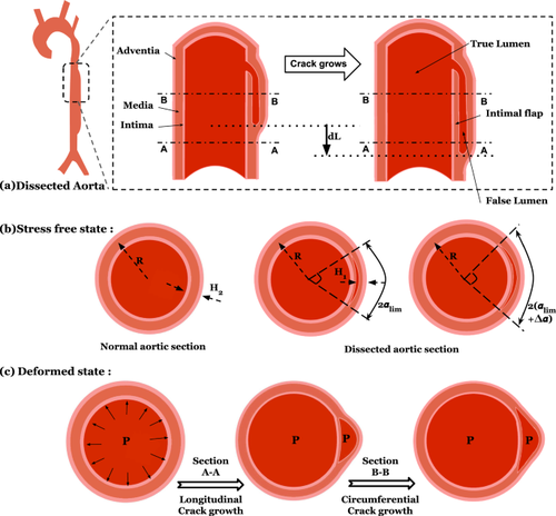 Fracture mechanics modeling of aortic dissection