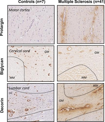 A role for vessel-associated extracellular matrix proteins in multiple sclerosis pathology