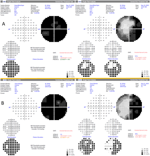 Rapid Vision Loss Due to Multifocal Glioma: A Diagnostic Challenge.