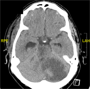 Locked-in syndrome following elective cervical foraminotomy: a case report