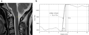 Super-resolution Deep Learning Reconstruction Cervical Spine 1.5T MRI: Improved Interobserver Agreement in Evaluations of Neuroforaminal Stenosis Compared to Conventional Deep Learning Reconstruction