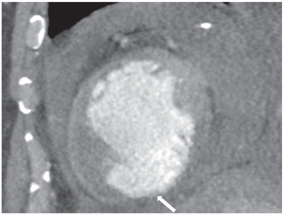 A Leaky False Pouch: Left Ventricle Pseudoaneurysm with Active Hemopericardium Detected on Cardiac Computed Tomography Angiography.
