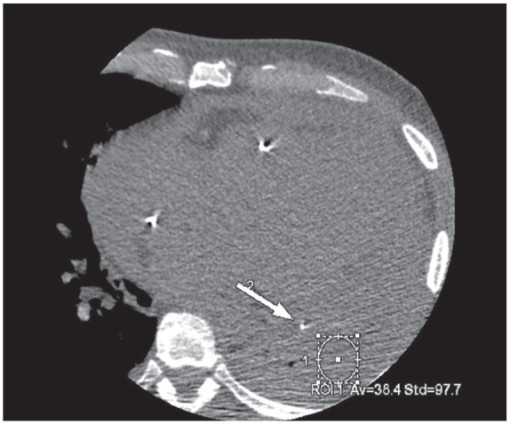 A Leaky False Pouch: Left Ventricle Pseudoaneurysm with Active Hemopericardium Detected on Cardiac Computed Tomography Angiography.