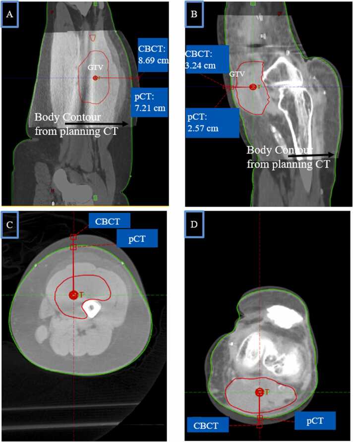 Cone-Beam CT Images as an Indicator of QACT During Adaptive Proton Therapy of Extremity Sarcomas.