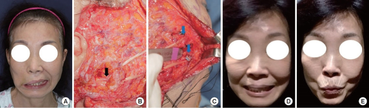 Sural nerve grafts in subacute facial nerve injuries: a report of two cases.