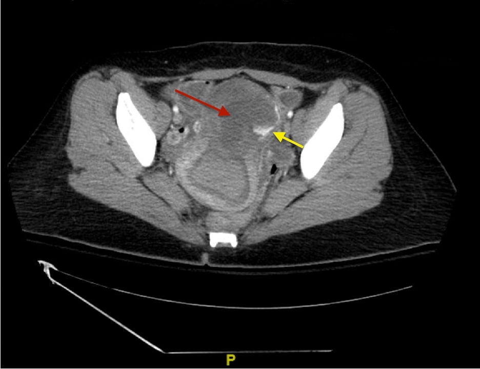 Vaginal Bleeding Due to Iatrogenic Uterine Perforation - A Case Report.