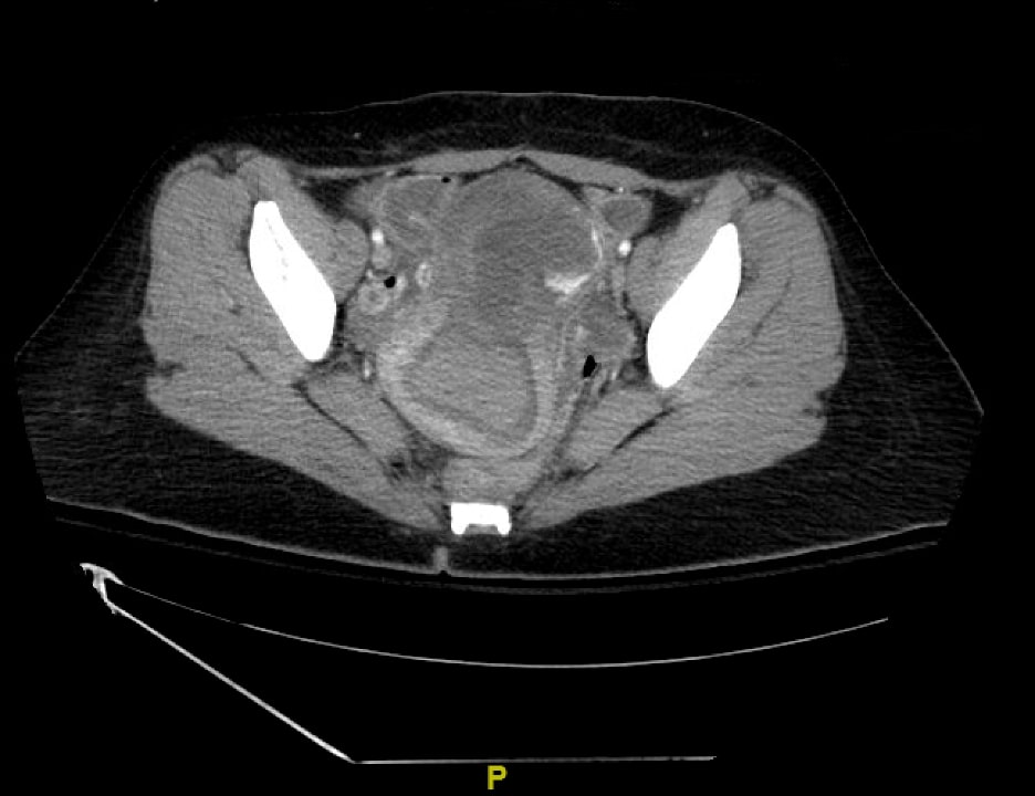 Vaginal Bleeding Due to Iatrogenic Uterine Perforation - A Case Report.