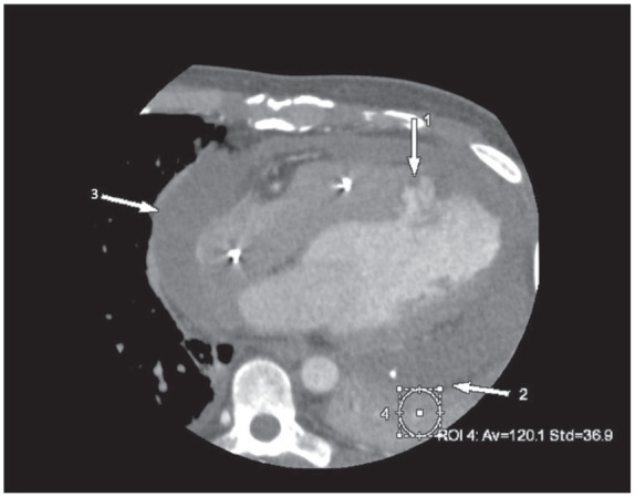 A Leaky False Pouch: Left Ventricle Pseudoaneurysm with Active Hemopericardium Detected on Cardiac Computed Tomography Angiography.