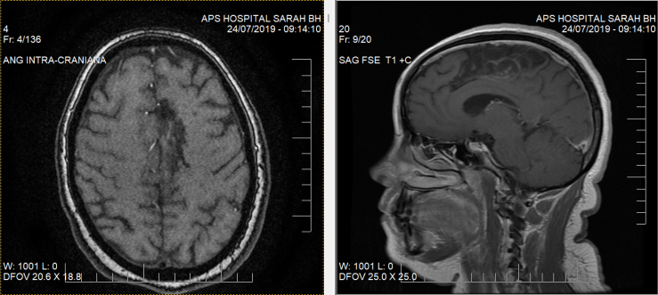 Reading and writing from right to left after anterior cerebral artery stroke.