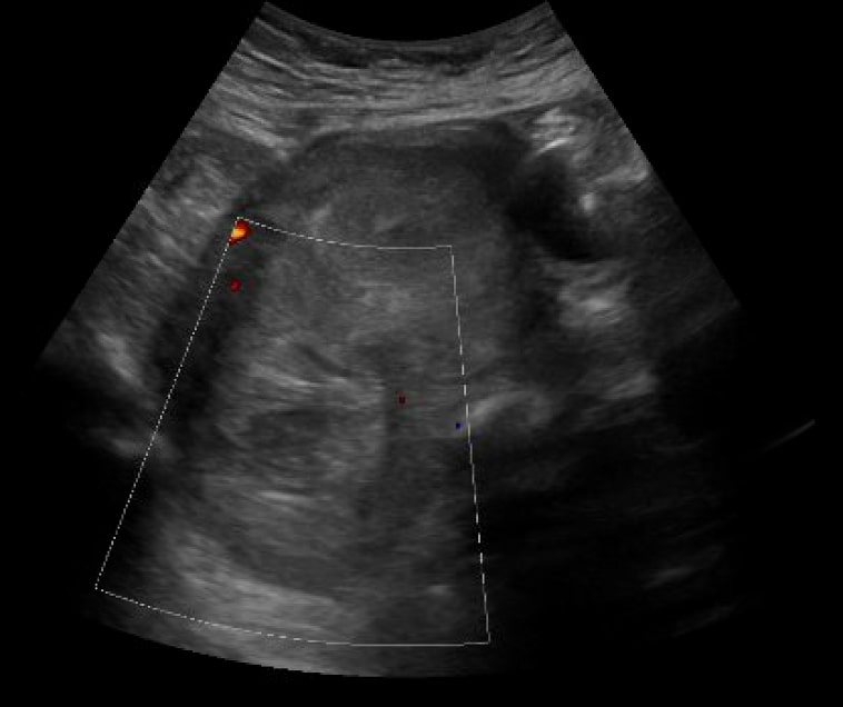 Vaginal Bleeding Due to Iatrogenic Uterine Perforation - A Case Report.