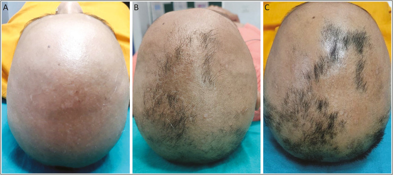 Modified platelet rich plasma therapy for alopecia totalis.