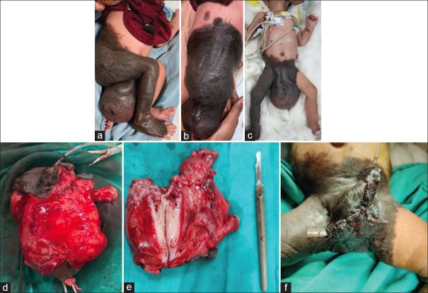 Neonatal Paratesticular Scrotal Mass: A Rare Case of Atypical Neurofibromatous Neoplasm with Uncertain Biologic Potential.